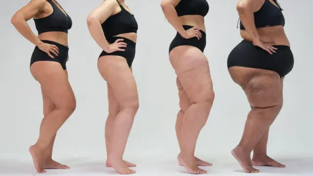 Nutrição como Aliada no Tratamento do Lipedema: Estratégias e Benefícios